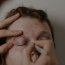 blefaroplastia