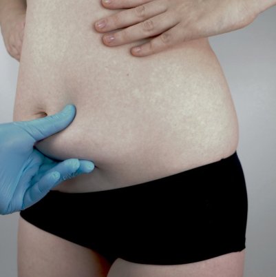 miniabdominoplastia